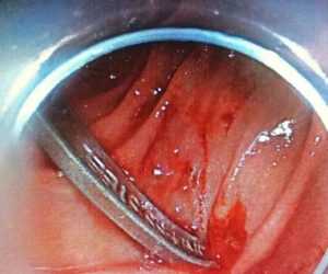 Surgeons Remove Cutlery From Teen’s Stomach