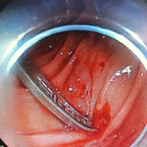 Read more about the article Surgeons Remove Cutlery From Teen’s Stomach