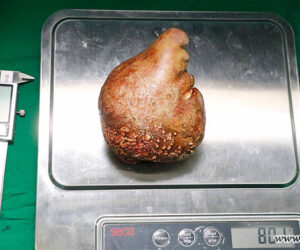 World’s Biggest Kidney Stone Removed