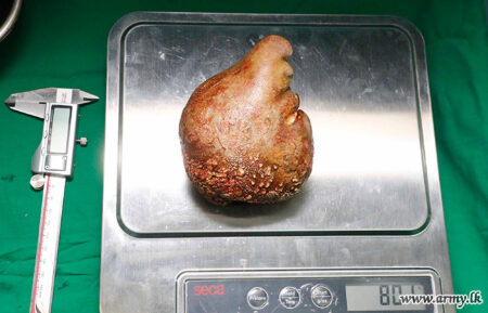 Read more about the article World’s Biggest Kidney Stone Removed