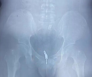 Surgeons Remove 25 Magnetic Beads From Teen’s Bladder After He Stuffed Them In His Genitals