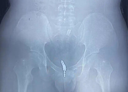 Read more about the article Surgeons Remove 25 Magnetic Beads From Teen’s Bladder After He Stuffed Them In His Genitals