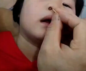  Father Removes Large Peanut From Three-Year-Old Daughter’s Nose Using A Toothpick