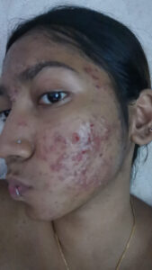 Read more about the article Beauty Treatment Left My Face With Oozing Sores, Says Patient