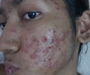 Beauty Treatment Left My Face With Oozing Sores, Says Patient