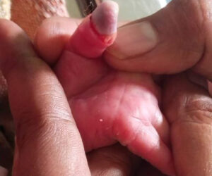 Bungling Medics Stick Baby Girl’s Half-Severed Thumb Back In Place With Tape