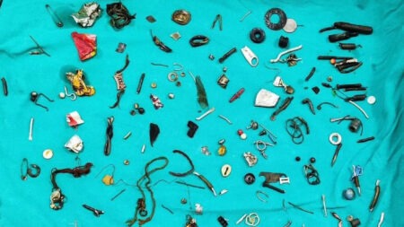 Read more about the article  Docs Find Dozens Of Nuts, Bolts, Jewellery And Ear Buds In Man’s Stomach