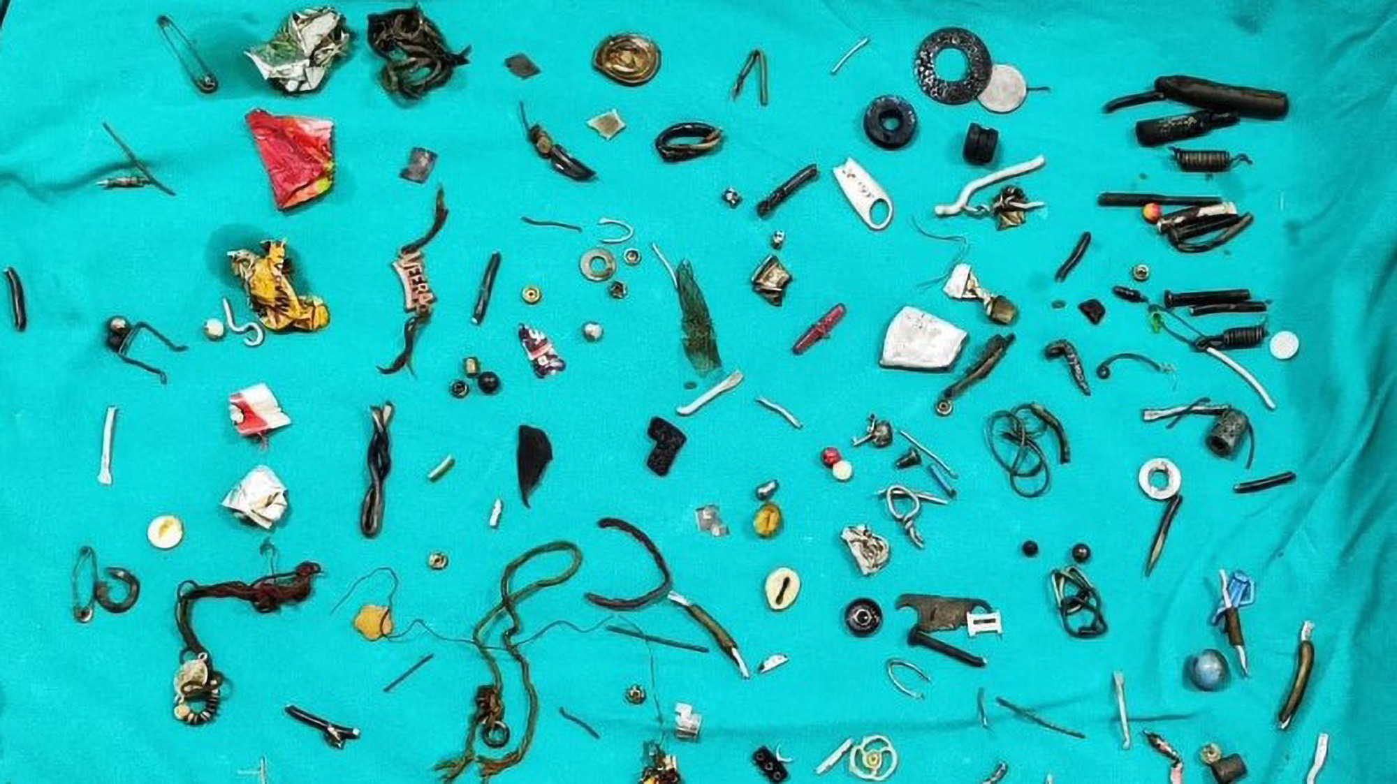  Docs Find Dozens Of Nuts, Bolts, Jewellery And Ear Buds In Man’s Stomach