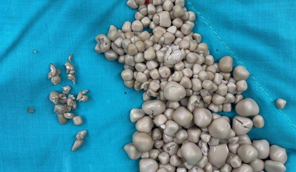 Medics Remove Over 300 Stones From Woman’s Kidney After She Drank Only Sweetened Drinks For Years